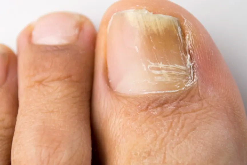 Causes Of Nail Fungal Infection